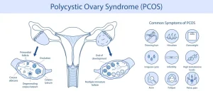 PCOS, Abortion in Bangalore