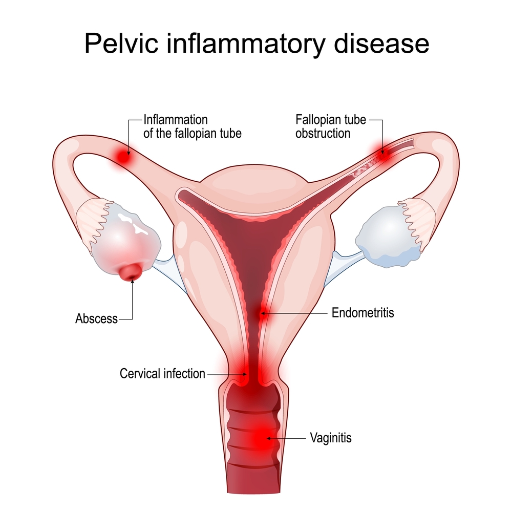 Unsafe abortion can cause PID but a safe abortion can prevent such complications.
