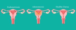 Adenomyosis and Endometriosis are different. A safe abortion does not cause any of these.